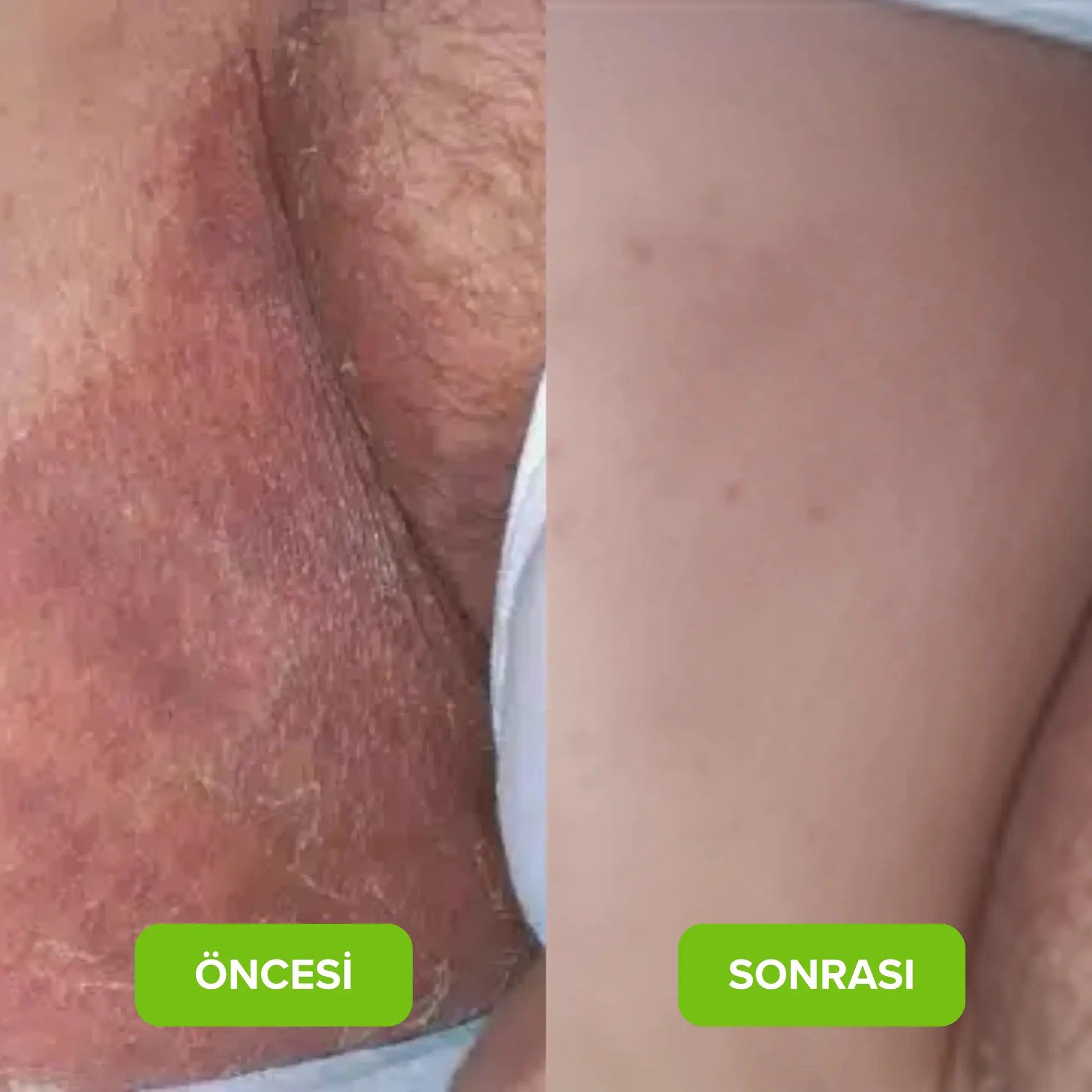 Karuvel® Mantar Karşıtı Sabun KARUVELCO