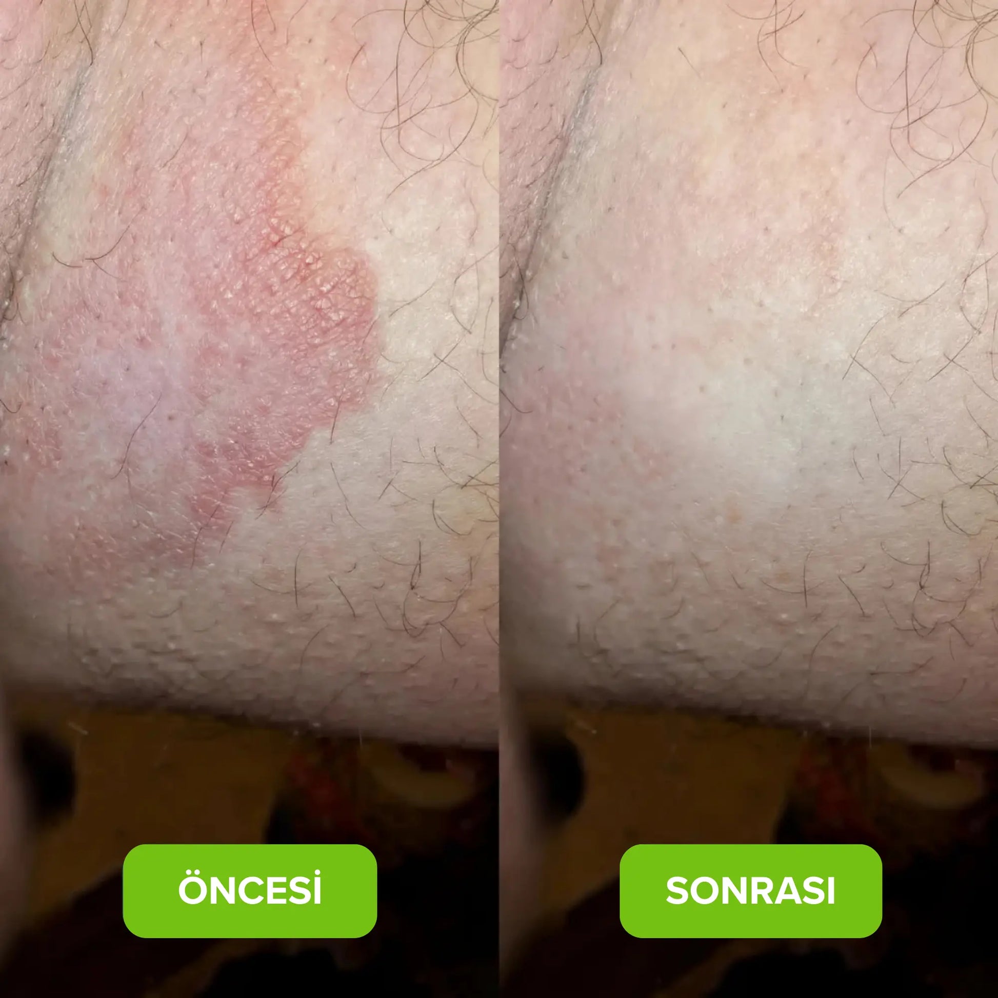 Karuvel® Mantar Karşıtı Sabun KARUVELCO