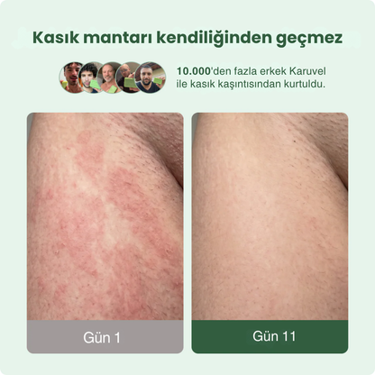 Karuvel® Mantar Karşıtı Sabun
